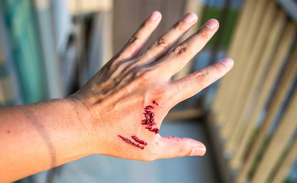 পোষা কুকুর ও বিড়াল কামড়ালে বা আঁচড় দিলে কি জলাতঙ্ক হতে পারে?