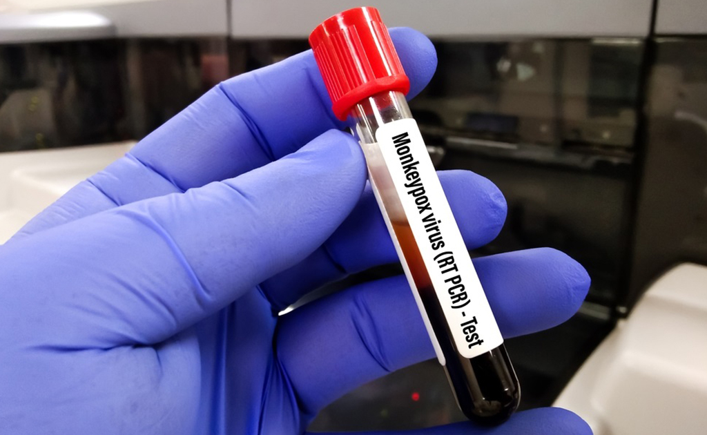 মাঙ্কিপক্স | আতঙ্কিত না হয়ে সচেতন হোন, সুস্থ থাকুন!