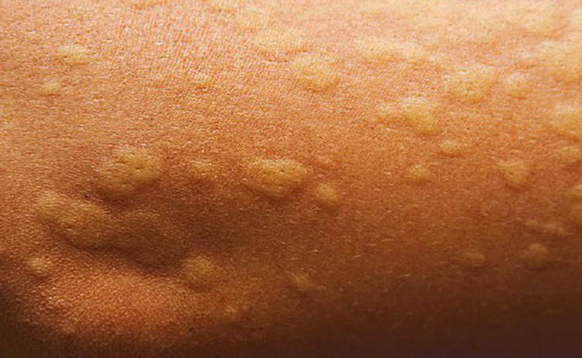 খাবারে অ্যালার্জি | ৪ ধরনের খাদ্যে অজান্তে আপনিও ভুগছেন না তো?