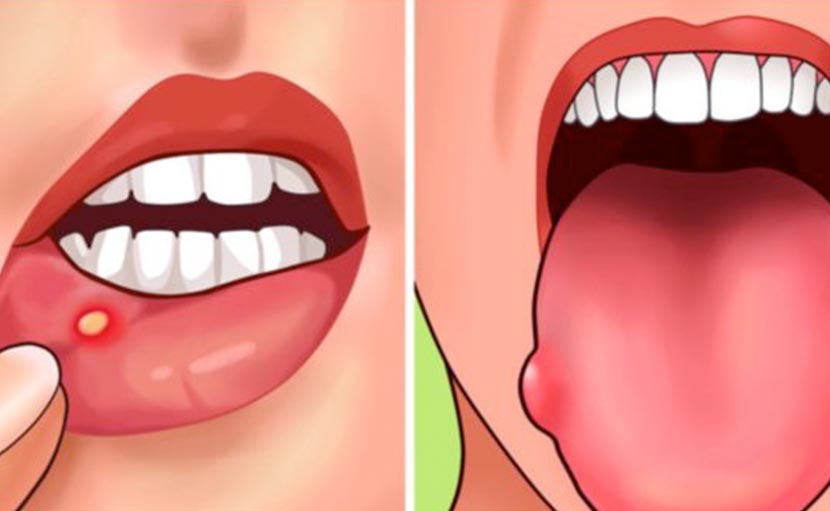 মুখের ঘা | ৩ ধরণের এপথাস আলসার এর কারণ ও চিকিৎসা জানেন?