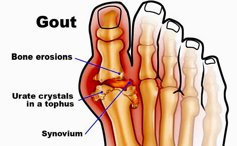 গাউট বা গেঁটে বাত হওয়ার কারণ, ধরণ ও নিয়ন্ত্রণে কী খাবেন?