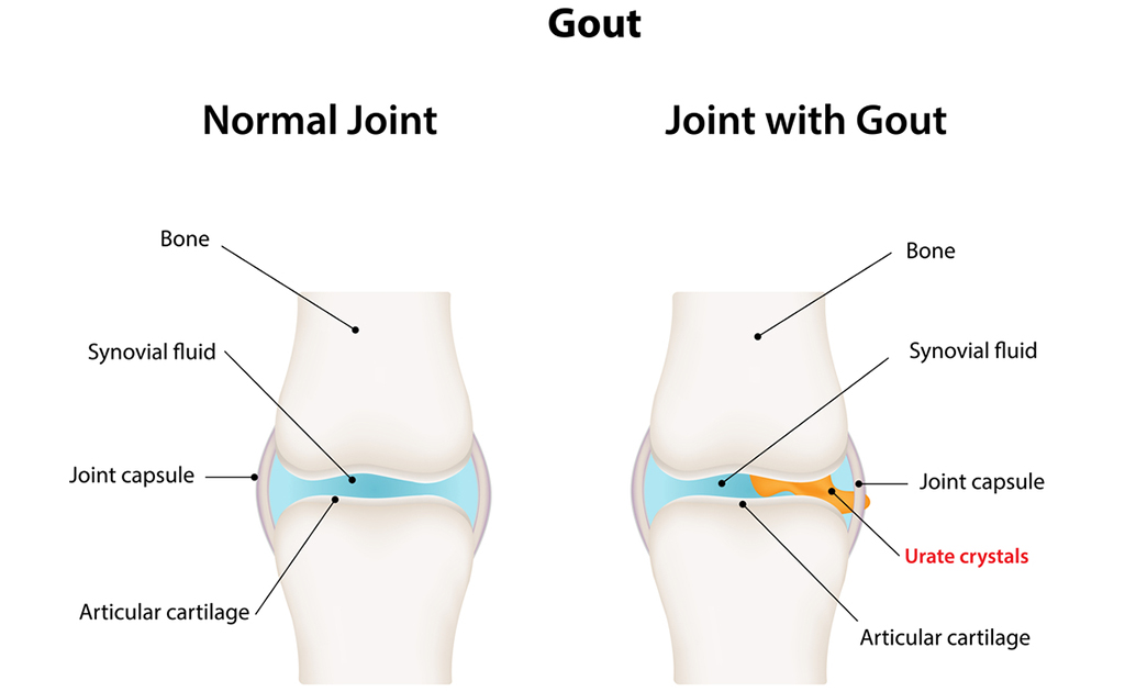 ইউরিক অ্যাসিড বাড়িয়ে দিচ্ছে গাউট বা গেঁটে বাত এর ব্যথা?