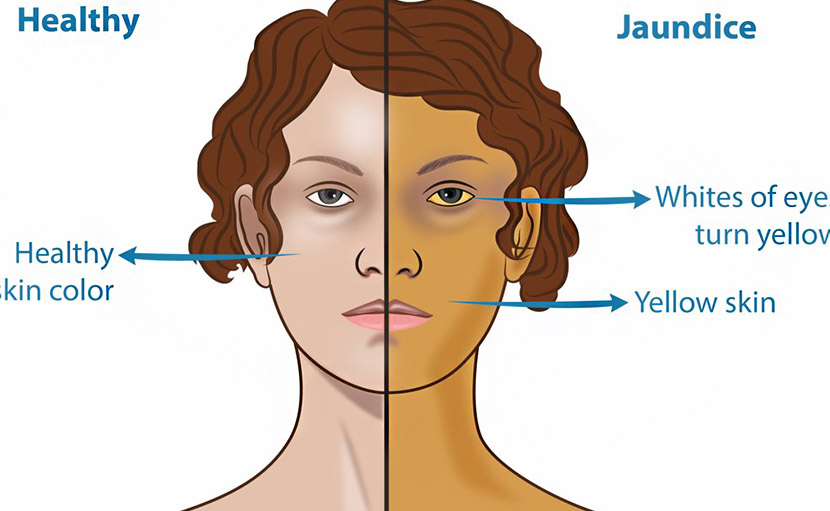 জন্ডিস রোগীর লক্ষণ, পথ্য ও খাবার তালিকা কেমন হওয়া চাই?