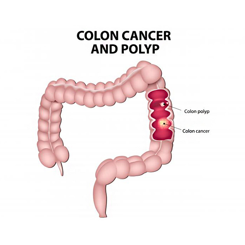 কোলন ক্যান্সার | কোলোরেক্টাল এর লক্ষণ, কারণ ও চিকিৎসা জানেন কি?