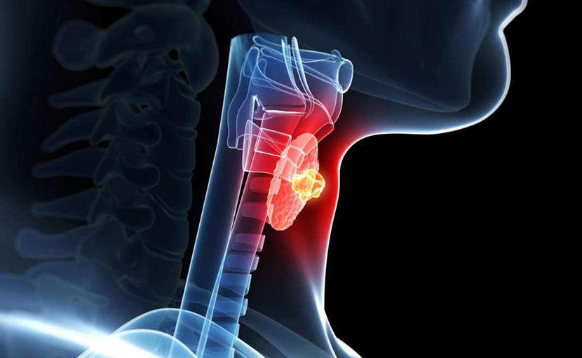 হাইপোথাইরয়েডিজম সমস্যা | ৭ ধরণের খাবার এড়িয়ে চলে সুস্থ থাকুন!