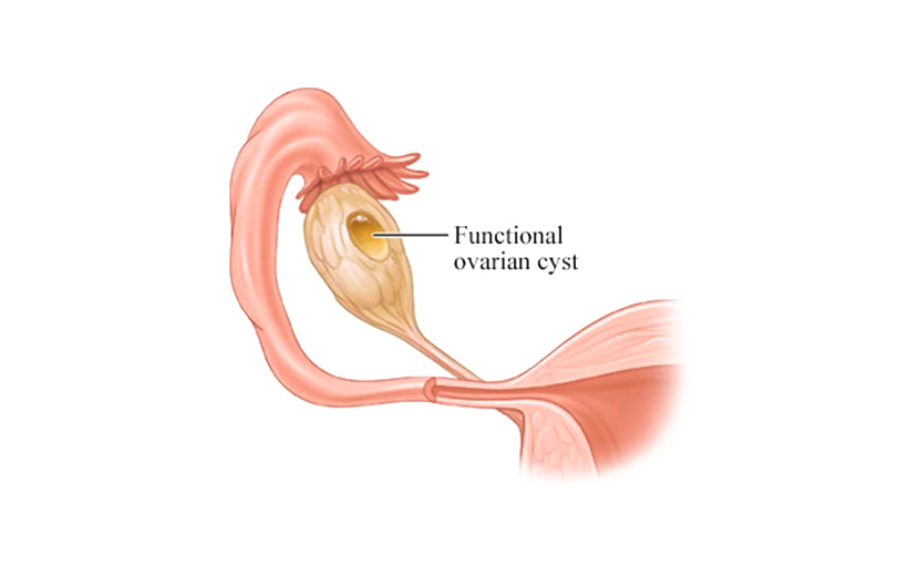 ফাংশনাল ওভারিয়ান সিস্ট | লক্ষণ ও চিকিৎসা জানেন কি?