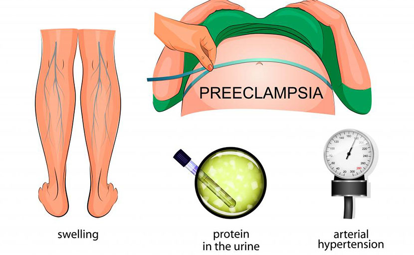 গর্ভাবস্থায় উচ্চ রক্তচাপ | প্রি-এক্লাম্পসিয়ার কারণ, লক্ষণ ও চিকিৎসা