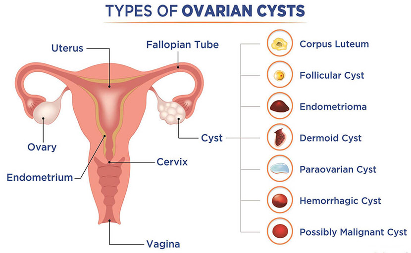 ওভারিয়ান সিস্ট নাকি টিউমার | কখন কী করা উচিত?