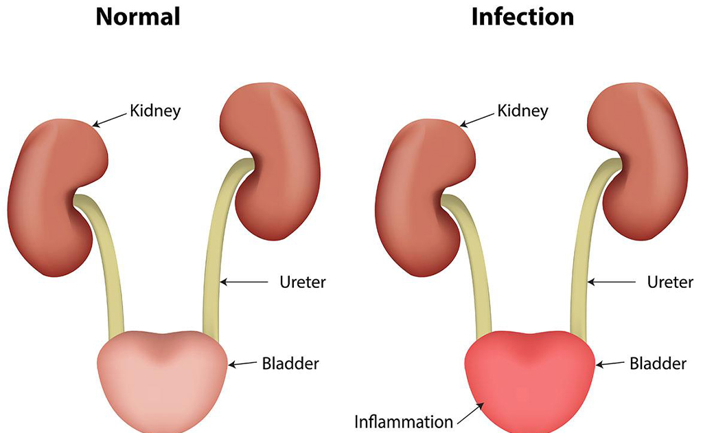 প্রস্রাবে জ্বালাপোড়ার কারণ ও ঘরোয়া প্রতিকারের ৫টি উপায়